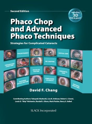 Phaco Chop and Advanced Phaco Techniques